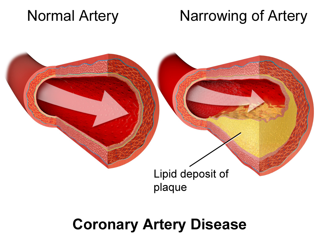 Correlation between BP swings and heart attack risk