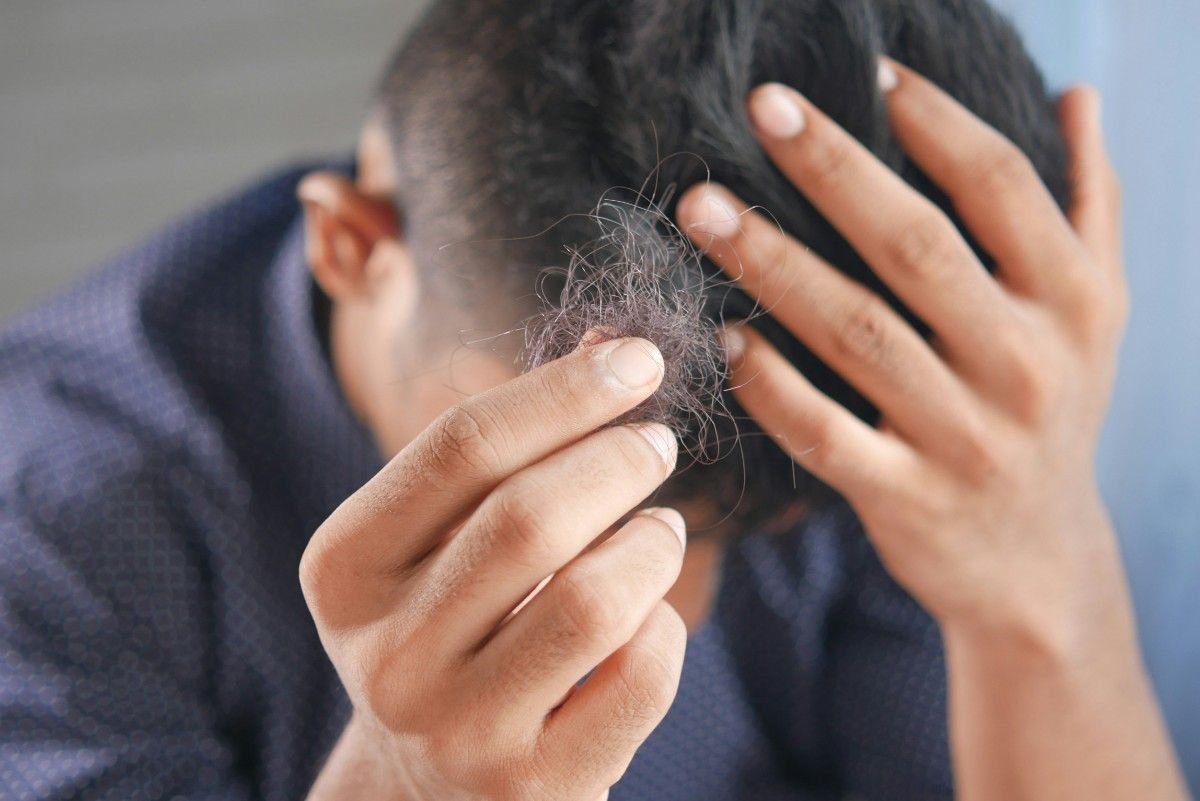 Hair fall vitamin deficiency — woman checking hair loss
